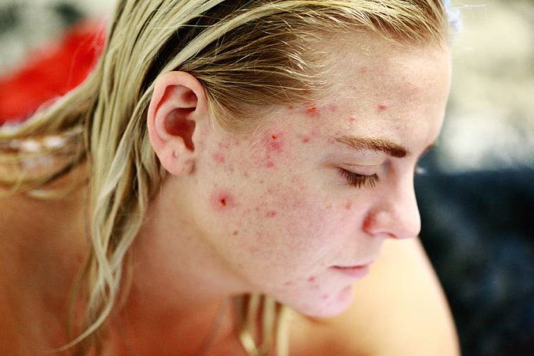 Natural acne treatment is the best