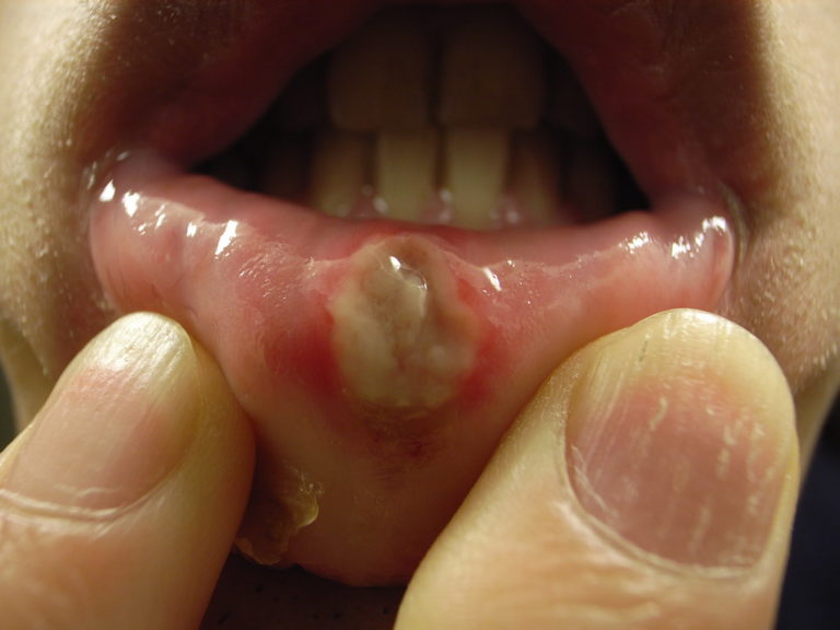 What kind of canker sores for me?